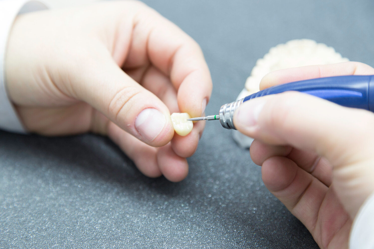 Vollkeramische+Teilkrone+Zahnkrone