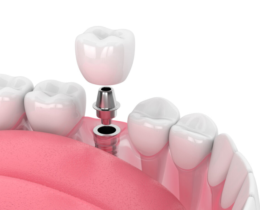 Implantat, Zahnimplantation