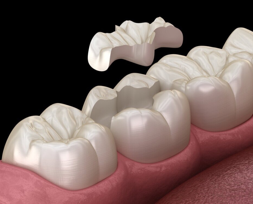 Inlay inlays, Zahnfüllung, Zahnarzt Ottobrunn