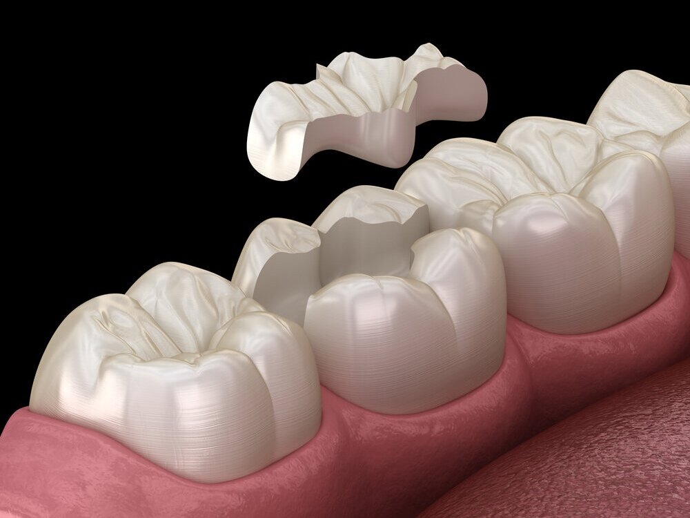 Inlay inlays, Zahnfüllung, Zahnarzt Ottobrunn
