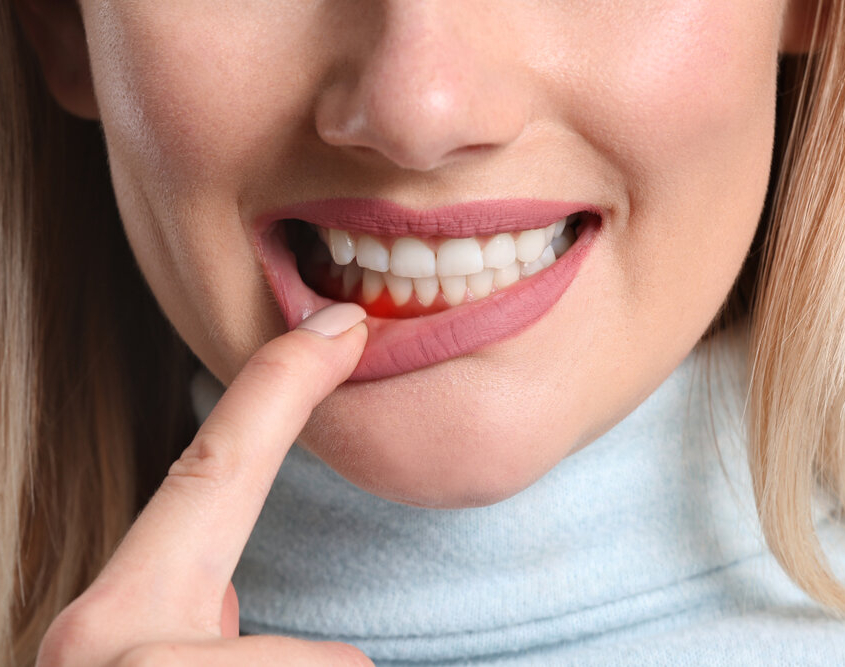 Zahnfleischentzündung, Paradontitis