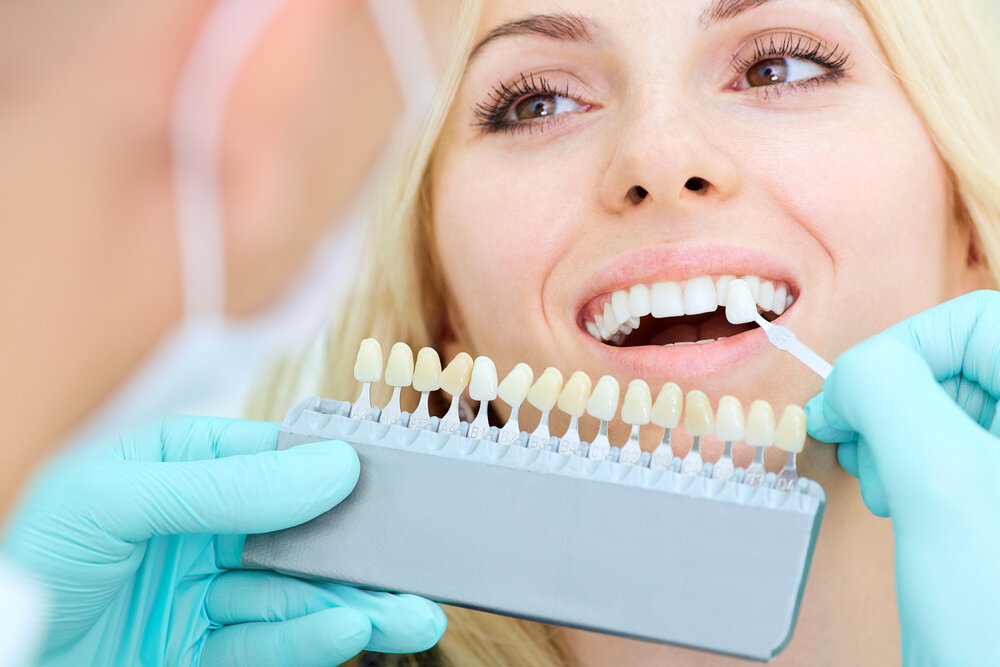 Veneers, Bleaching, Zahnaufhellung