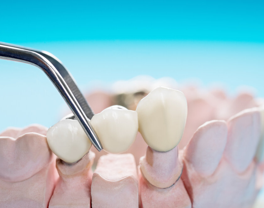 Krone, Brücke, Prothese