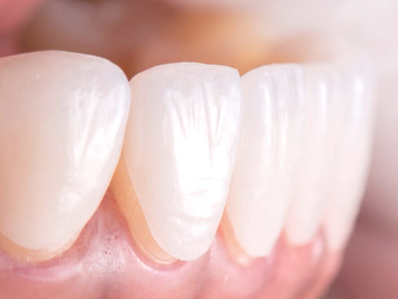 Ästhetische Zahnmedizin: Veneers